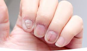 Nail Fungus Treatment and Prevention